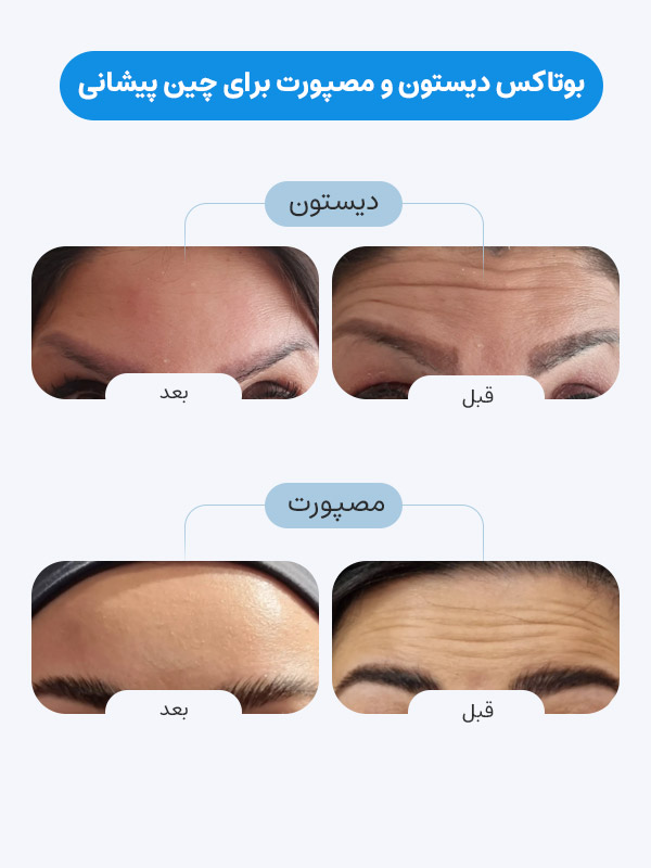 مقایسه بوتاکس دیستون و مصپورت برای چین پیشانی