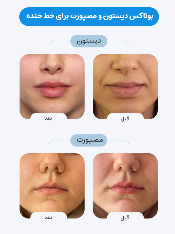 مقایسه بوتاکس دیستون و مصپورت برای خط خنده