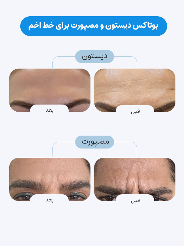 مقایسه بوتاکس دیستون و مصپورت برای خط اخم