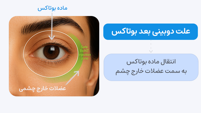 علت دوبینی بعد بوتاکس: انتقال ماده بوتاکس به سمت عضلات خارج‌ چشم