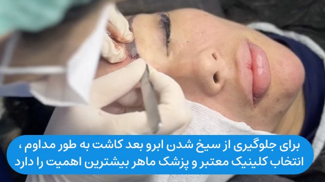 برای جلوگیری از سیخ شدن ابرو بعد کاشت به طور مداوم ، انتخاب کلینیک معتبر و پزشک ماهر بیشترین اهمیت را دارد.