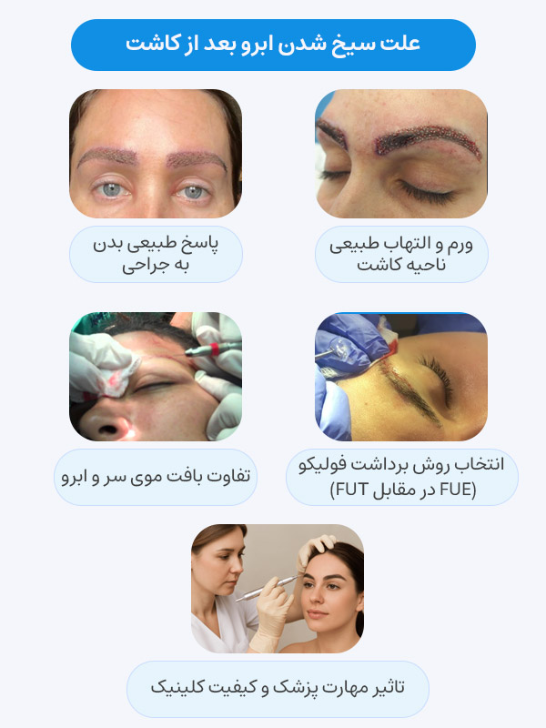 علت مسواکی شدن ابرو بعد از کاشت