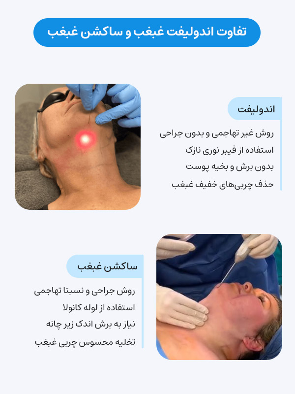 تفاوت اندولیفت غبغب و ساکشن غبغب