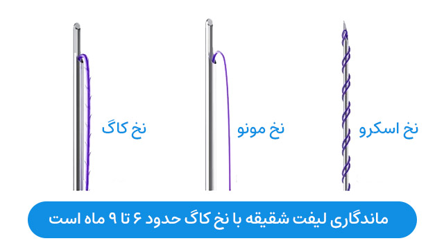 ماندگاری لیفت شقیقه با نخ کاگ حدود 6 تا 9 ماه است.