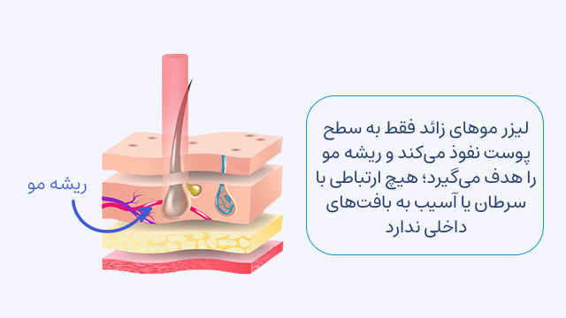 لیزر موهای زائد فقط به سطح پوست نفوذ میکند و ریشه مو را هدف میگیرد؛ هیچ ارتباطی با سرطان یا آسیب به بافتهای داخلی ندارد.