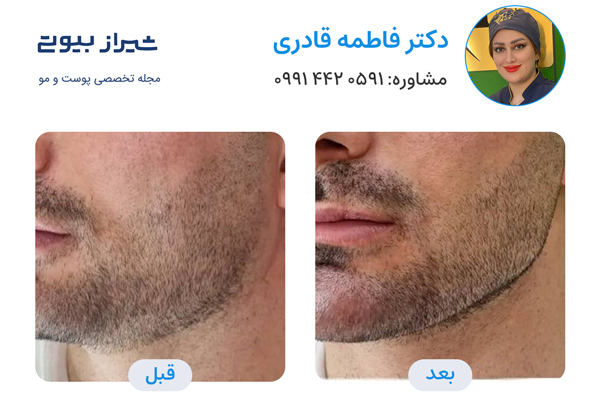 تزریق ژل در صدرا - دکتر فاطمه قادری
