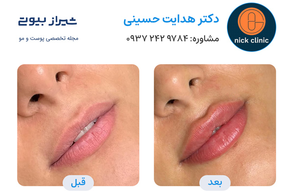 تزریق ژل در صدرا - دکتر هدایت حسینی