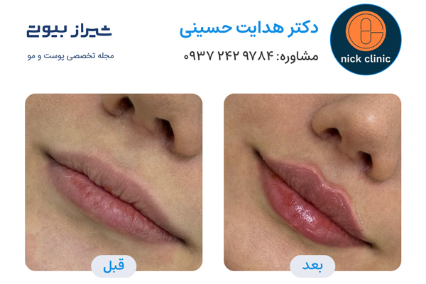 تزریق ژل در صدرا - دکتر هدایت حسینی
