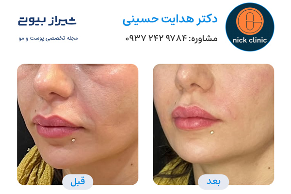 تزریق ژل در صدرا - دکتر هدایت حسینی