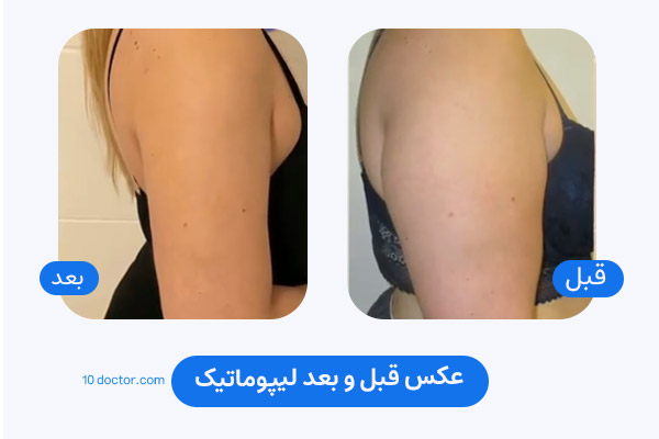 عکس قبل و بعد لیپوماتیک