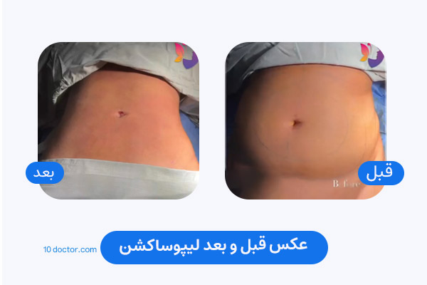 عکس قبل و بعد لیپوساکشن