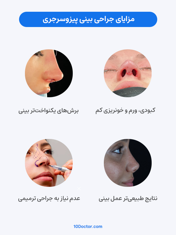 مزایای جراحی بینی پیزوسرجری