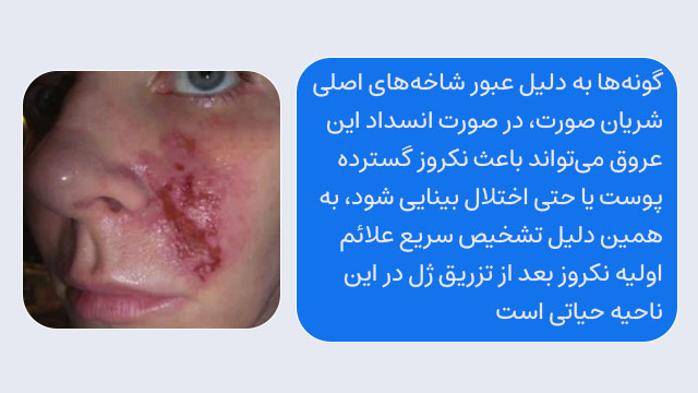 نکروز ناحیه گونه بعد ژل