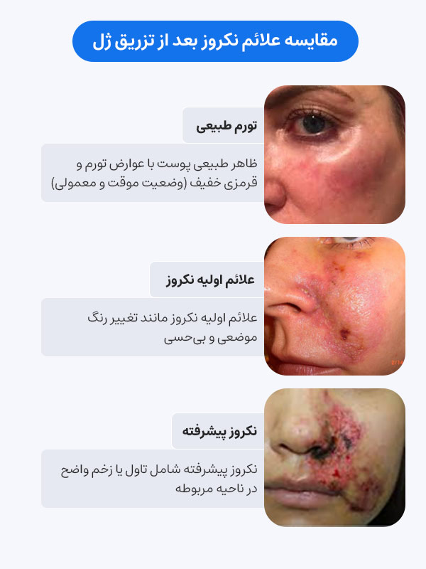 مقایسه علائم نکروز بعد از تزریق ژل 