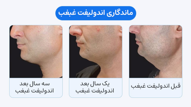 ماندگاری اندولیفت غبغب