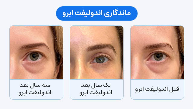 ماندگاری اندولیفت ابرو و دور چشم