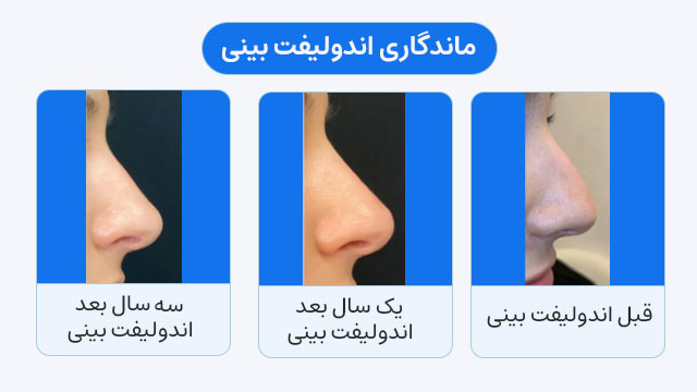 ماندگاری اندولیفت بینی