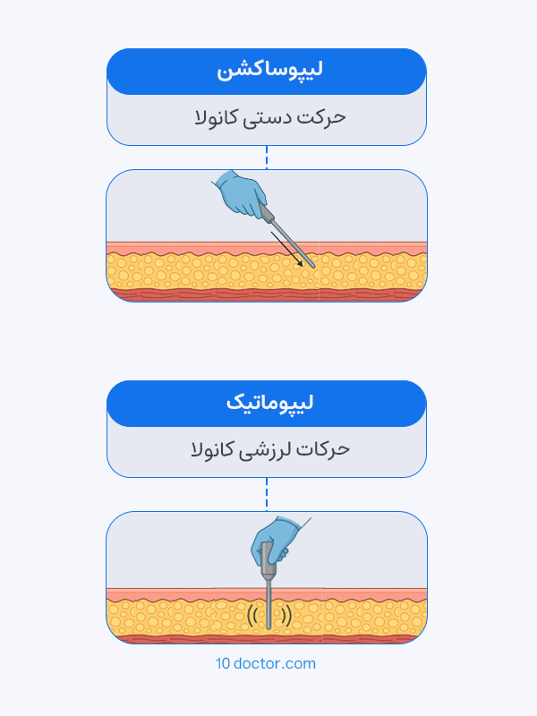 لیپوساکشن: حرکت دستی کانولا
لیپوماتیک: حرکات لرزشی کانولا