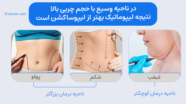 در ناحیه وسیع با حجم چربی بالا، نتیجه لیپوماتیک بهتر از لیپوساکشن است.