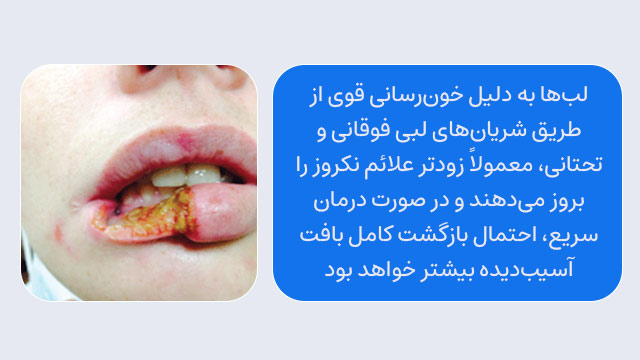  نکروز لب (لب بالا و پایین) بعد تزریق ژل