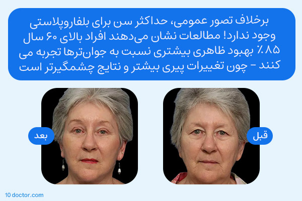 برخلاف تصور عمومی، حداکثر سن برای بلفاروپلاستی وجود ندارد! مطالعات نشان میدهند افراد بالای 60 سال 85% بهبود ظاهری بیشتری نسبت به جوانترها تجربه میکنند - چون تغییرات پیری بیشتر و نتایج چشمگیرتر است.