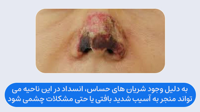 نکروز بینی بعد از تزریق ژل
