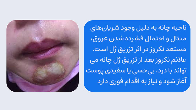 نکروز در ناحیه چانه بعد ژل
