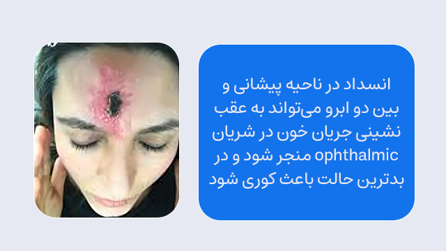نکروز پیشانی و ناحیه بین دو ابرو
