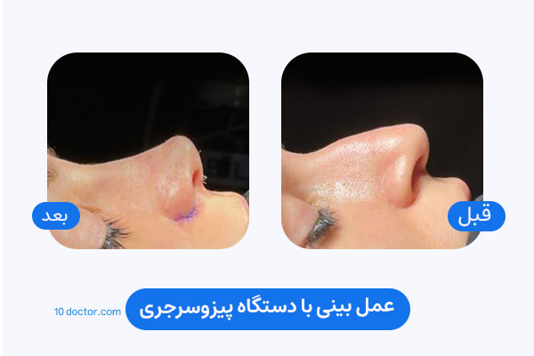 عمل بینی با دستگاه پیزوسرجری | تصویر قبل و بعد