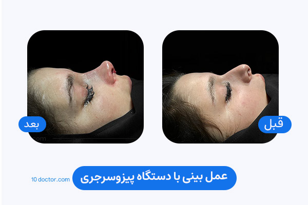 عمل بینی با دستگاه پیزوسرجری | تصویر قبل و بعد