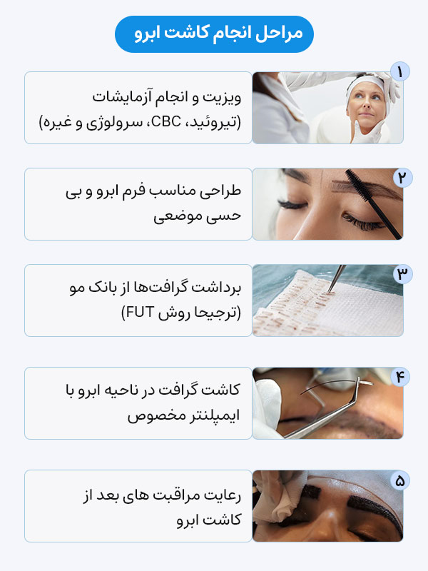 Steps for eyebrow transplantation