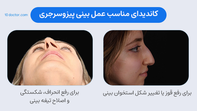 کاندیدای مناسب عمل بینی پیزوسرجری