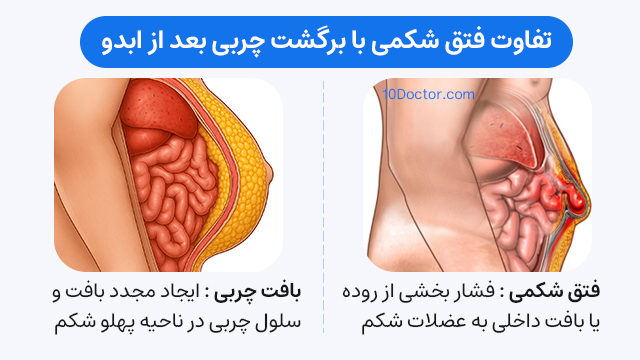 تفاوت فتق شکمی با برگشت چربی بعد از ابدو