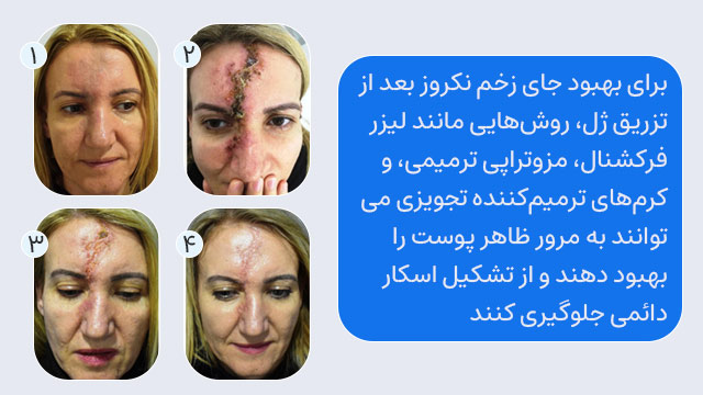درمان نکروز بعد از تزریق ژل