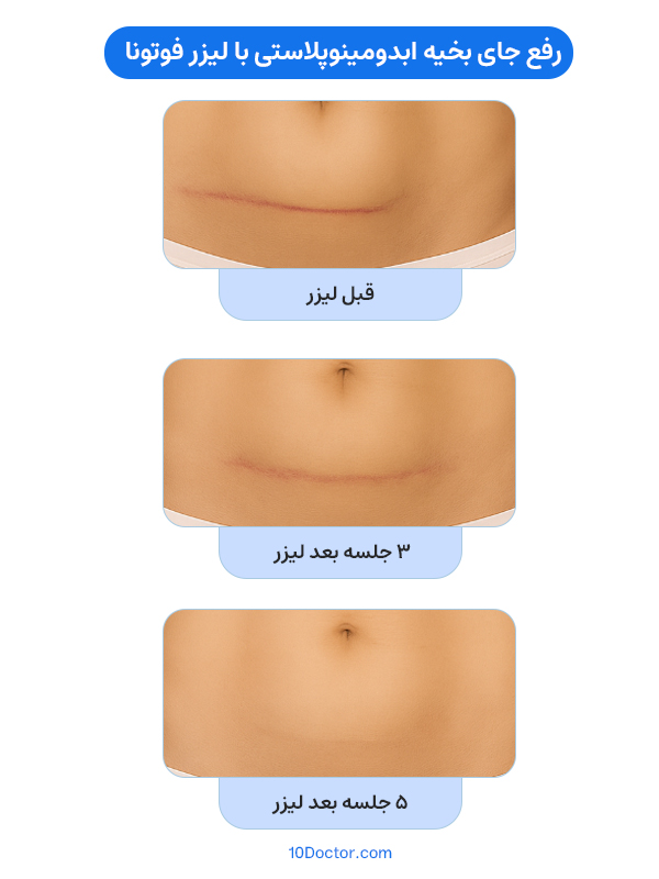 رفع جای بخیه ابدومینوپلاستی با لیزر فوتونا