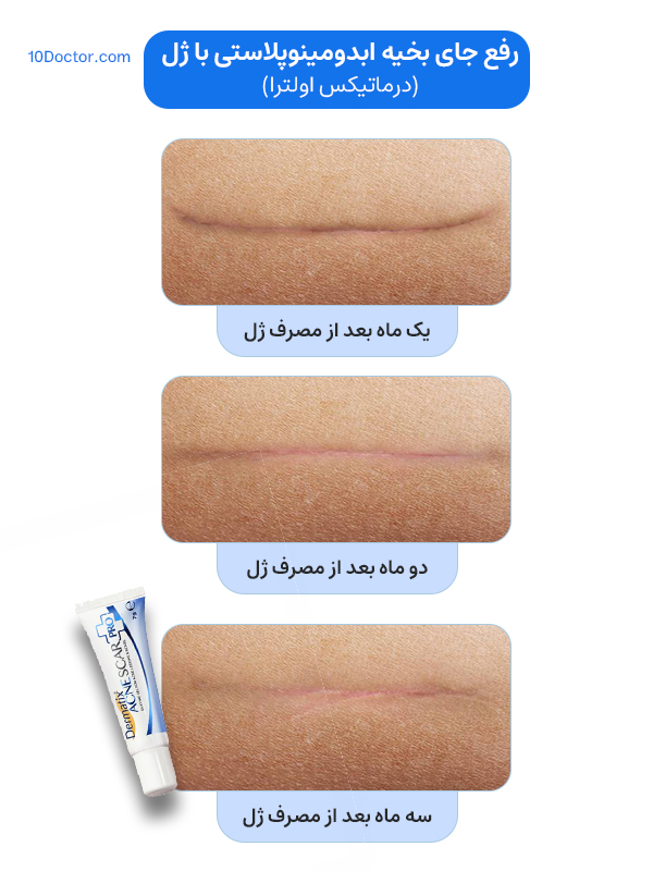 رفع جای بخیه ابدومینوپلاستی با ژل (درماتیکس اولترا)
