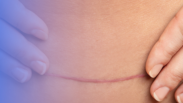 Abdominoplasty suture removal
