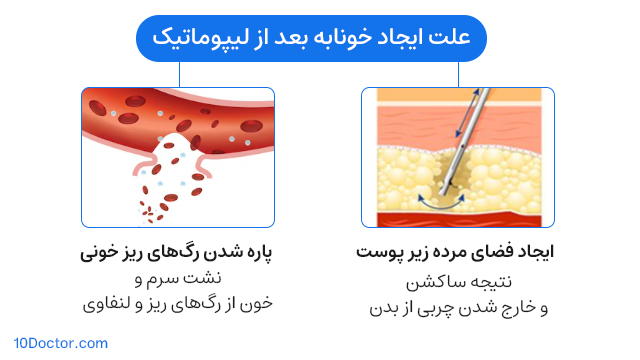 Causes of seroma after liposuction