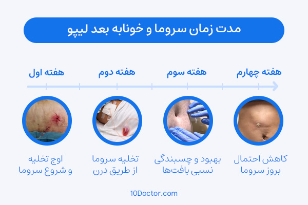مدت زمان سروما و خونابه بعد لیپو