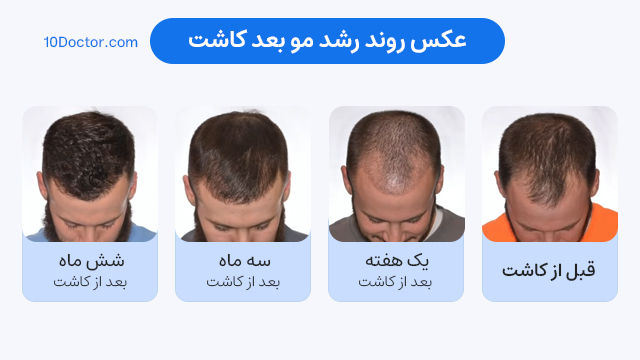 عکس روند رشد مو بعد کاشت