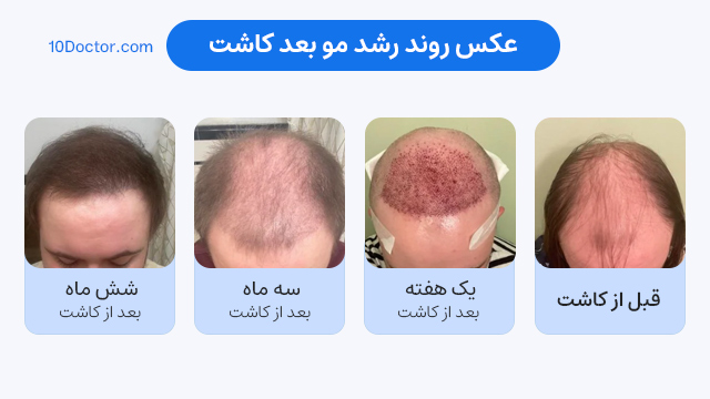 عکس روند رشد مو بعد کاشت