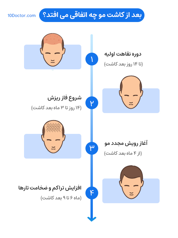 بعد از کاشت مو چه اتفاقی می افتد؟