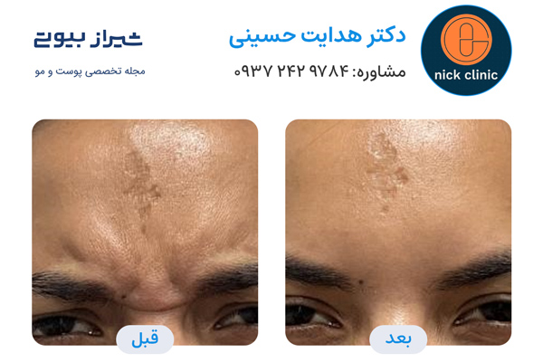 تزریق بوتاکس در صدرا - دکتر هدایت حسینی