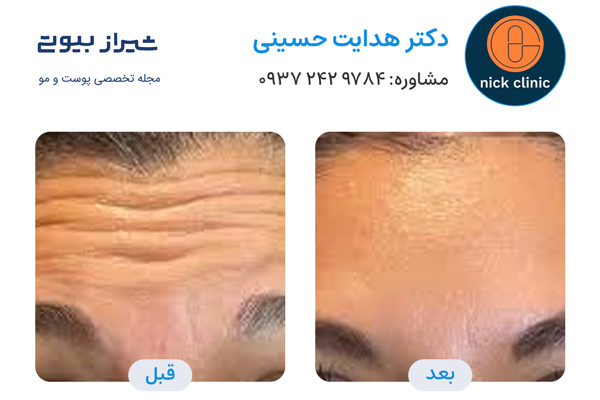 تزریق بوتاکس در صدرا - دکتر هدایت حسینی