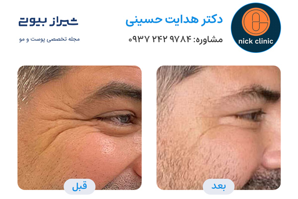 تزریق بوتاکس در صدرا - دکتر هدایت حسینی