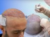 نتیجه کاشت مو بعد از چند ماه مشخص میشود ؟