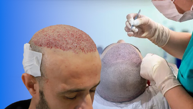 نتیجه کاشت مو بعد از چند ماه مشخص میشود ؟