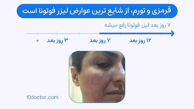 قرمزی و تورم، از شایع ترین عوارض لیزر فوتونا است.