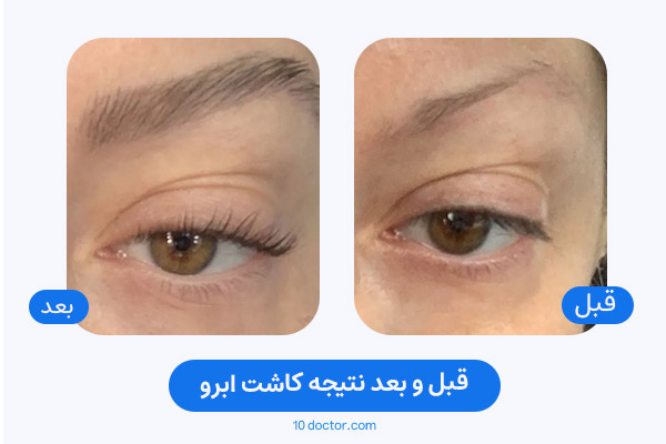 قبل و بعد نتیجه کاشت ابرو