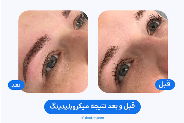قبل و بعد نتیجه میکروبلیدینگ